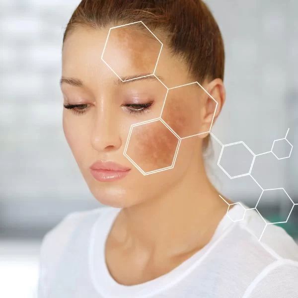 tratamente-leziuni-pigmentare-ploiesti-dermatologie.jpg