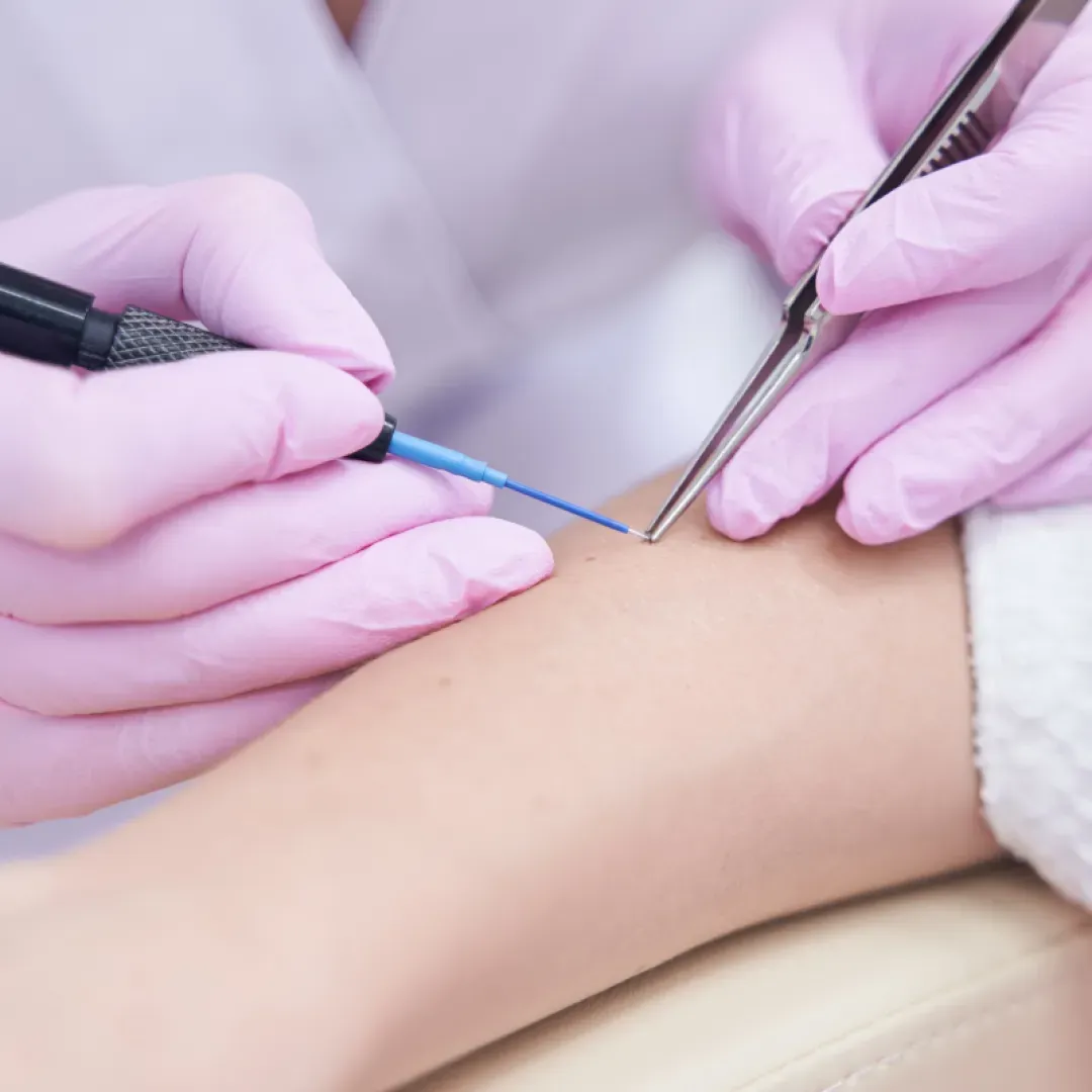 Intervenții dermatologice
