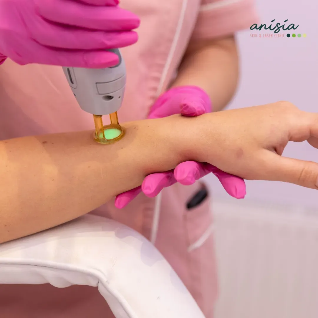 laser-hair-removal laser-hair-removal.webp