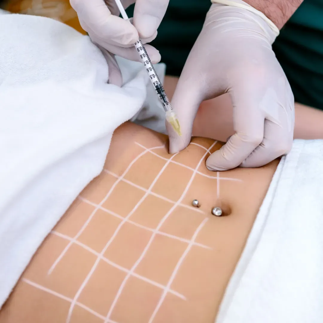 Lipoliza injectabilă